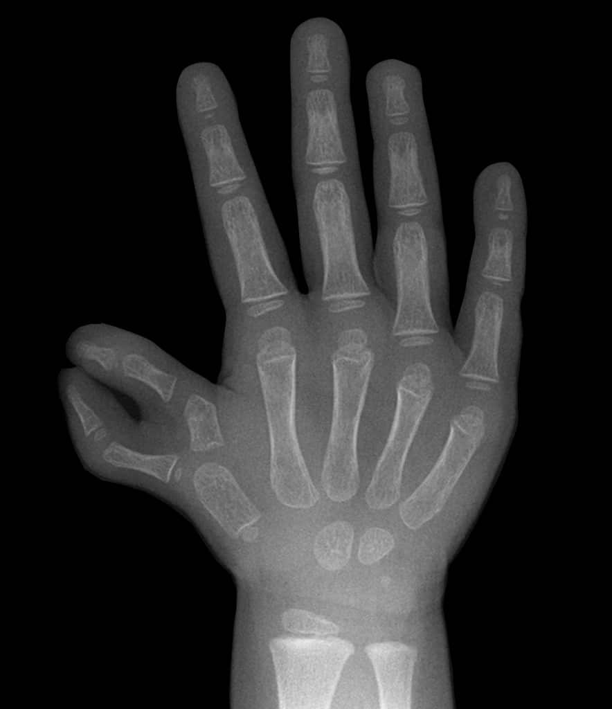 preaxial polydactyly